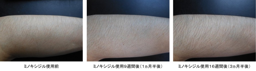 ミノキシジル使用３ヵ月半後の腕の変化