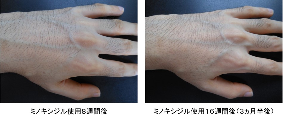 ミノキシジル使用３ヵ月半後の手の甲の変化